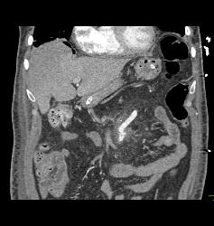 Repair of Superior Mesenteric Artery (SMA) Aneurysm With Post Op Changes - CTisus CT Scan