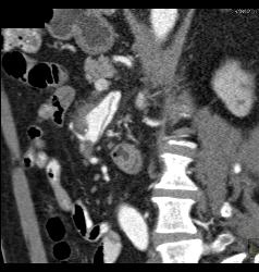 Superior Mesenteric Artery (SMA) Aneurysm - CTisus CT Scan