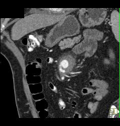 Superior Mesenteric Artery (SMA) Aneurysm - CTisus CT Scan