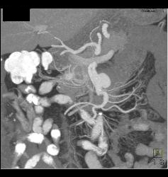 Superior Mesenteric Artery (SMA) Aneurysm - CTisus CT Scan