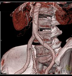 3D of IMA - CTisus CT Scan