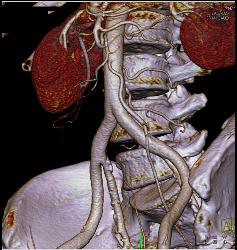 3D of IMA - CTisus CT Scan