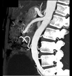 Median Arcuate Ligament - CTisus CT Scan