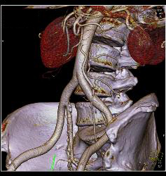 Median Arcuate Ligament - CTisus CT Scan