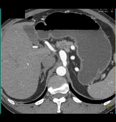 Celiac Artery Aneurysm - CTisus CT Scan