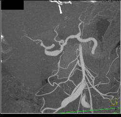 Ehlers-Danlos With Multiple Aneurysms Including Hepatic Artery - CTisus CT Scan