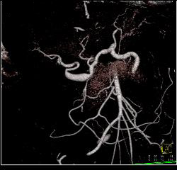 Ehlers-Danlos With Multiple Aneurysms Including Hepatic Artery - CTisus CT Scan