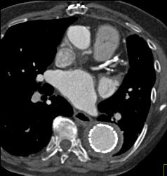 Endovascular Stent With Endoleak - CTisus CT Scan