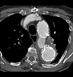 Endovascular Stent With Endoleak - CTisus CT Scan