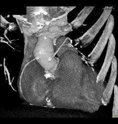 Endovascular Stent With Endoleak - CTisus CT Scan