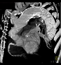 Endovascular Stent With Endoleak - CTisus CT Scan