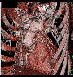 Endovascular Stent With Endoleak - CTisus CT Scan