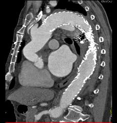 Endovascular Stent With Endoleak - CTisus CT Scan