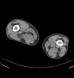 Hematoma Around Stent in Popliteal Artery. Stent Is Partially Occluded - CTisus CT Scan