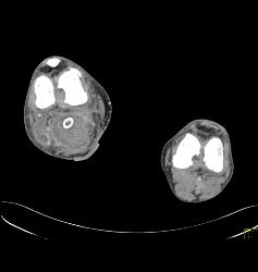 Hematoma Around Stent in Popliteal Artery. Stent Is Partially Occluded - CTisus CT Scan