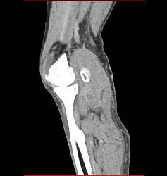 Hematoma Around Stent in Popliteal Artery. Stent Is Partially Occluded - CTisus CT Scan