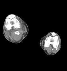 Hematoma Around Stent in Popliteal Artery. Stent Is Partially Occluded - CTisus CT Scan