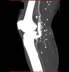 Hematoma Around Stent in Popliteal Artery. Stent Is Partially Occluded - CTisus CT Scan