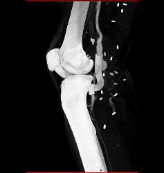 Hematoma Around Stent in Popliteal Artery. Stent Is Partially Occluded - CTisus CT Scan