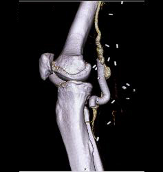 Hematoma Around Stent in Popliteal Artery. Stent Is Partially Occluded - CTisus CT Scan