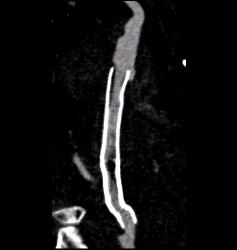 Hematoma Around Stent in Popliteal Artery. Stent Is Partially Occluded - CTisus CT Scan