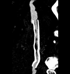 Hematoma Around Stent in Popliteal Artery. Stent Is Partially Occluded - CTisus CT Scan