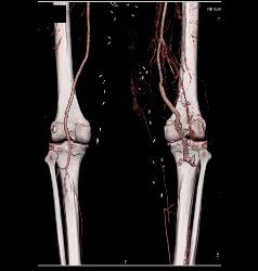 Peripheral Vascular Disease (PVD) With Stent Grafts - CTisus CT Scan