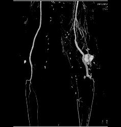 Peripheral Vascular Disease (PVD) With Stent Grafts - CTisus CT Scan