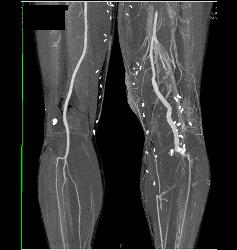 Peripheral Vascular Disease (PVD) With Stent Grafts - CTisus CT Scan