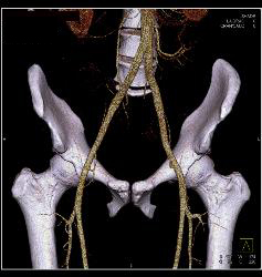 Atherosclerotic Disease Iliac Artery - CTisus CT Scan