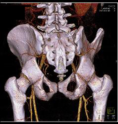 Atherosclerotic Disease Iliac Artery - CTisus CT Scan