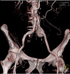 Iliac Artery Aneurysm - CTisus CT Scan