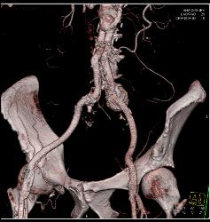 Iliac Artery Aneurysm - CTisus CT Scan