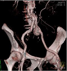 Iliac Artery Aneurysm - CTisus CT Scan