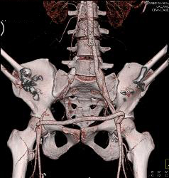 Fem-fem Bypass With Occluded Right Iliac Artery - CTisus CT Scan