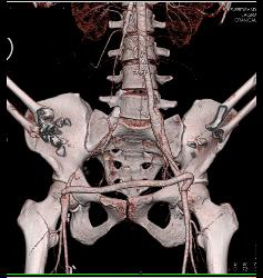 Fem-fem Bypass With Occluded Right Iliac Artery - CTisus CT Scan