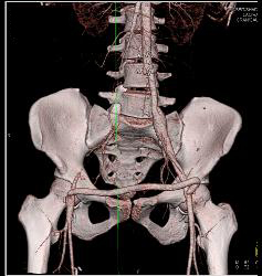 Fem-fem Bypass With Occluded Right Iliac Artery - CTisus CT Scan