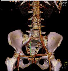 Fem-fem Bypass With Occluded Right Iliac Artery - CTisus CT Scan