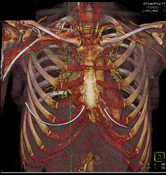 Fem-fem Bypass With Occluded Right Iliac Artery - CTisus CT Scan