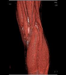 Patent Popliteal Artery and Trifurcation - CTisus CT Scan