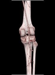 Patent Popliteal Artery and Trifurcation - CTisus CT Scan