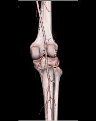 Patent Popliteal Artery and Trifurcation - CTisus CT Scan