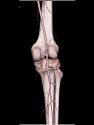 Patent Popliteal Artery and Trifurcation - CTisus CT Scan