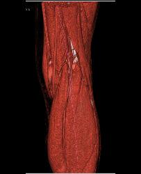 Patent Popliteal Artery and Trifurcation - CTisus CT Scan