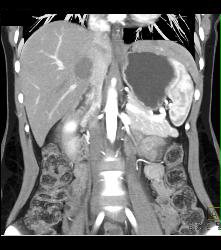 Patent Popliteal Artery and Trifurcation - CTisus CT Scan