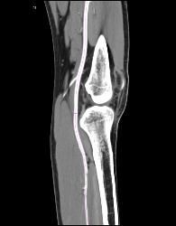 Patent Popliteal Artery and Trifurcation - CTisus CT Scan