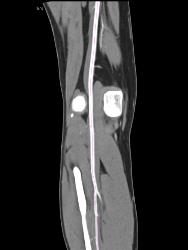 Patent Popliteal Artery and Trifurcation - CTisus CT Scan