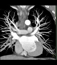 Bicuspid Valve - CTisus CT Scan