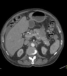 Multiple Incidental Pulmonary Emboli (PEs) in Patient With Pancreatic Cancer - CTisus CT Scan