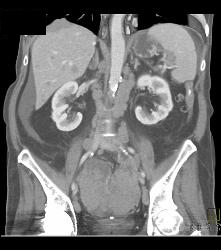 Multiple Incidental Pulmonary Emboli (PEs) in Patient With Pancreatic Cancer - CTisus CT Scan